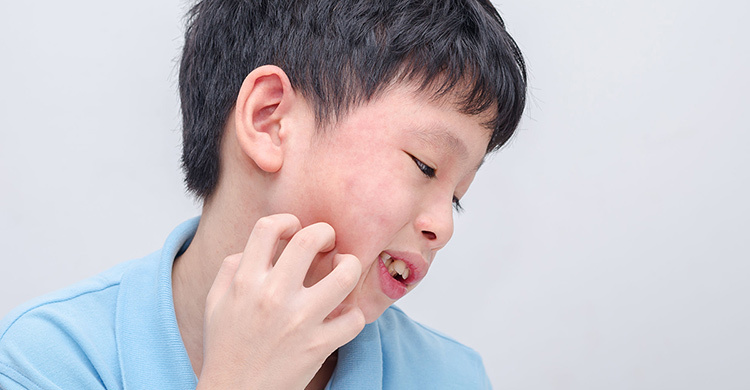 秋季，不少孩子出现荨麻疹，父母要注意什么呢？